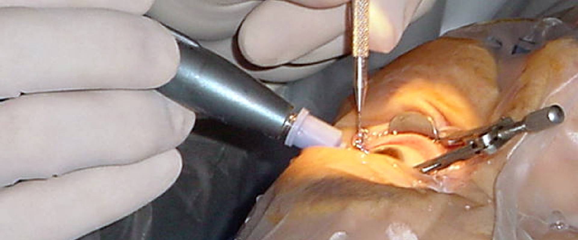 Phaco Surgery – Restore Clear Vision with Advanced Eye Care